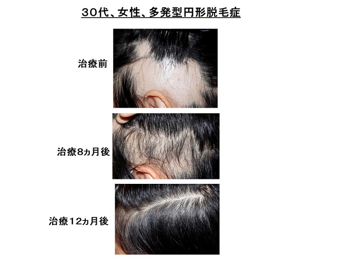 円形脱毛症　病院